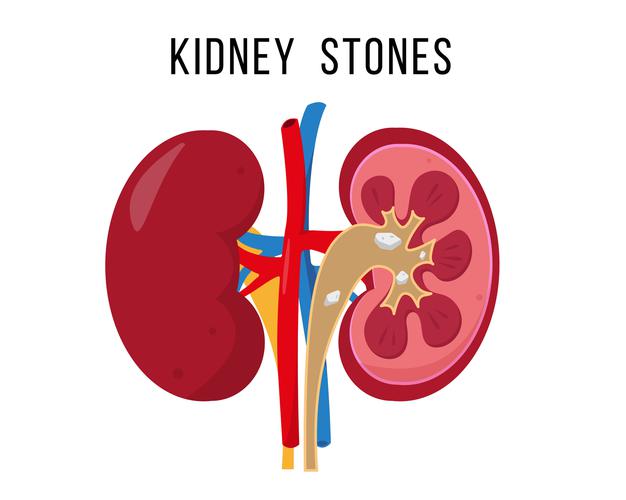 Best kidney stone treatment specialist