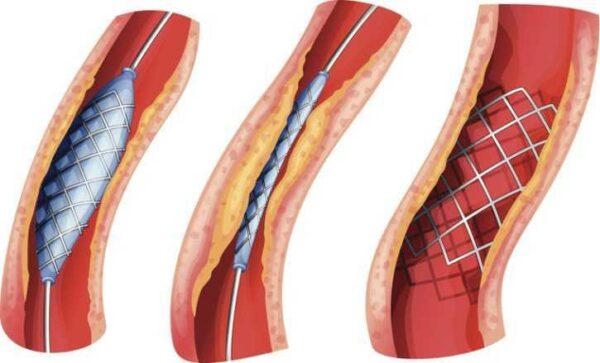 Atherectomy Devices Market 2021-2026: Industry Size, Share, Trends and Forecast