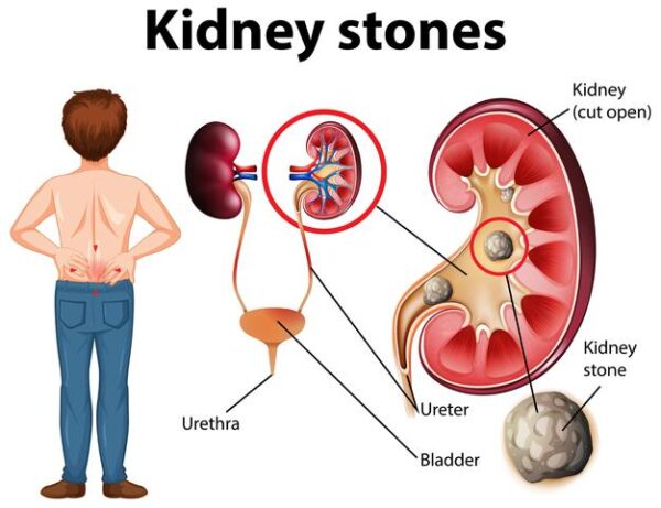 3 Steps for Preventing Kidney Stone Pain