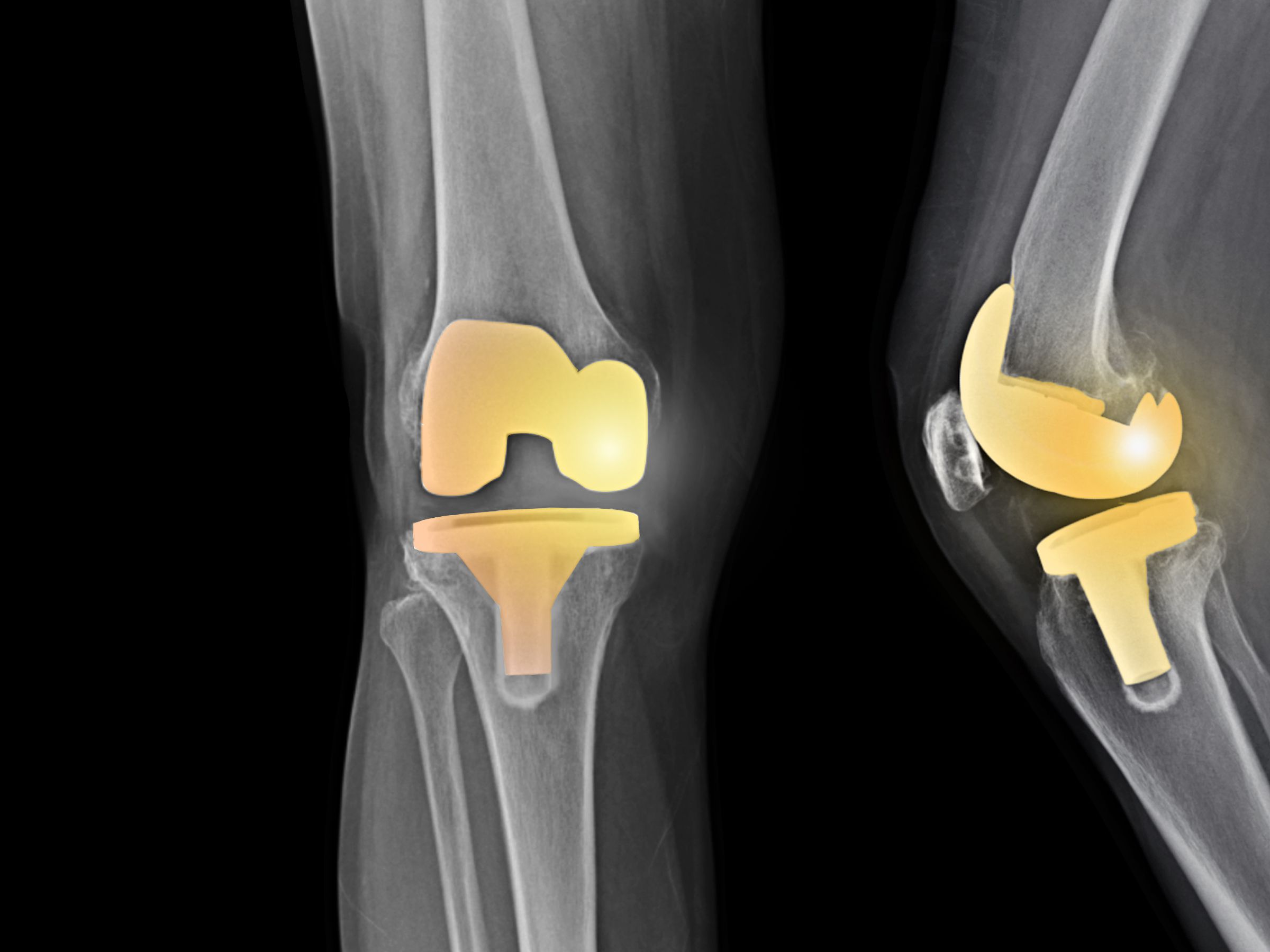 What is a Knee Replacement, And Why is it Needed?