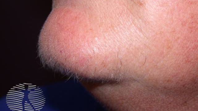 Why does Hirsutism Happen in Female?