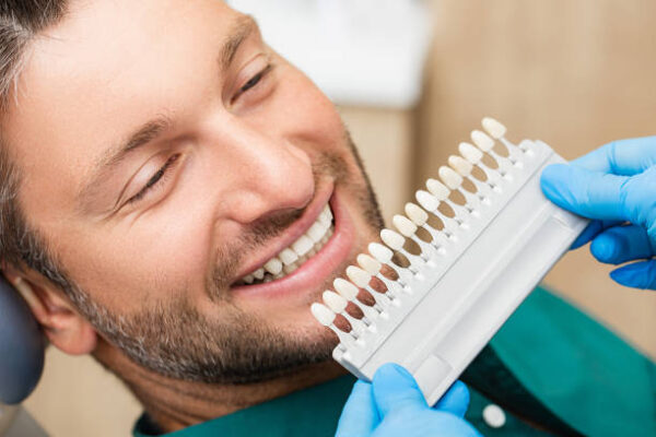 Dental veneers: price, lifespan, maintenance