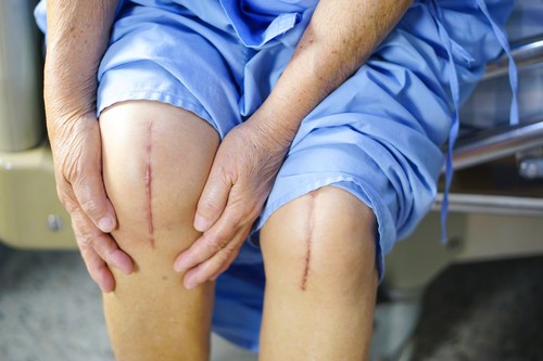 Total Knee Replacement Surgery & Cost in Delhi, India