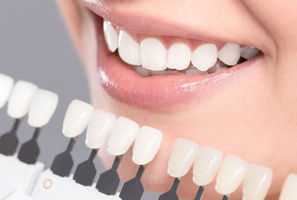 Porcelain Veneers – Who Can Benefit From This Procedure?