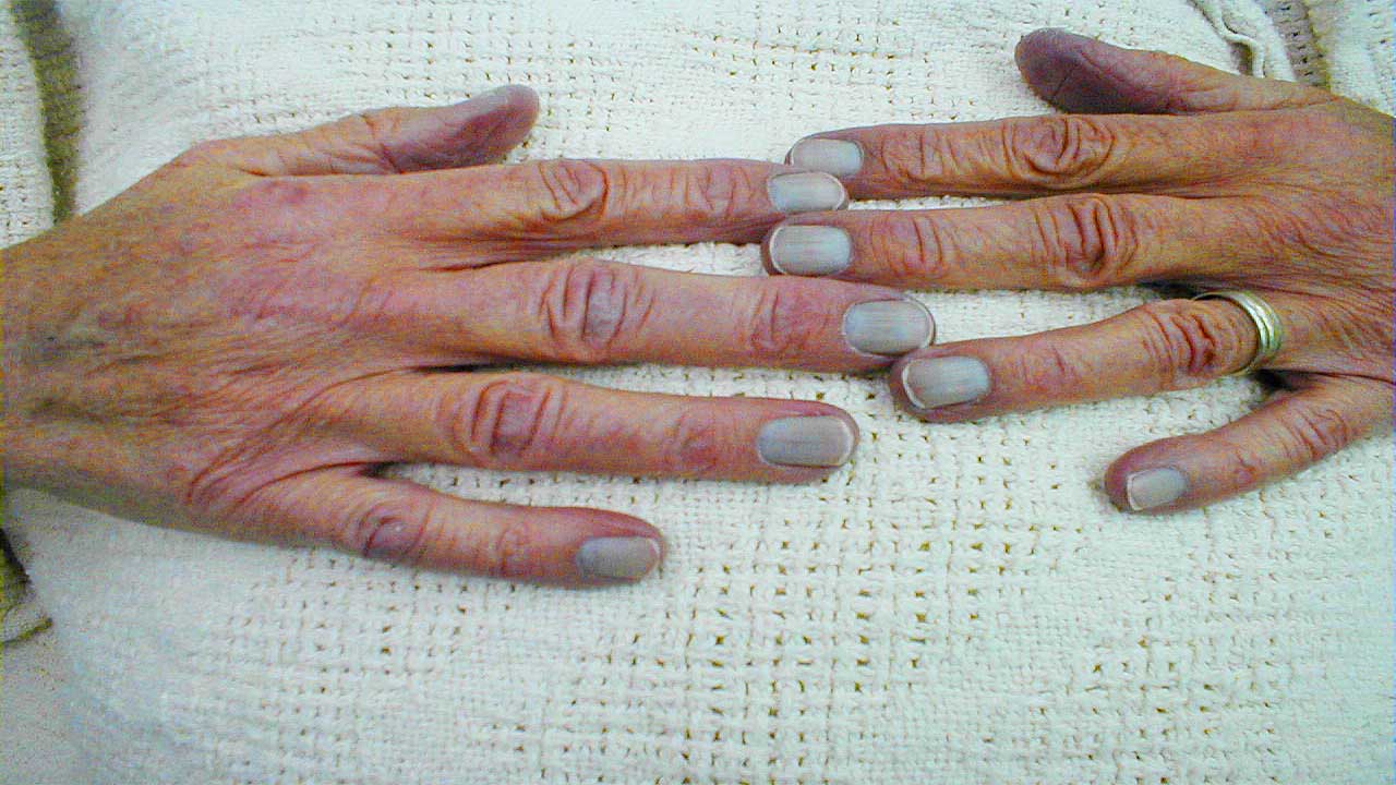 Health Risks of Blue Nails