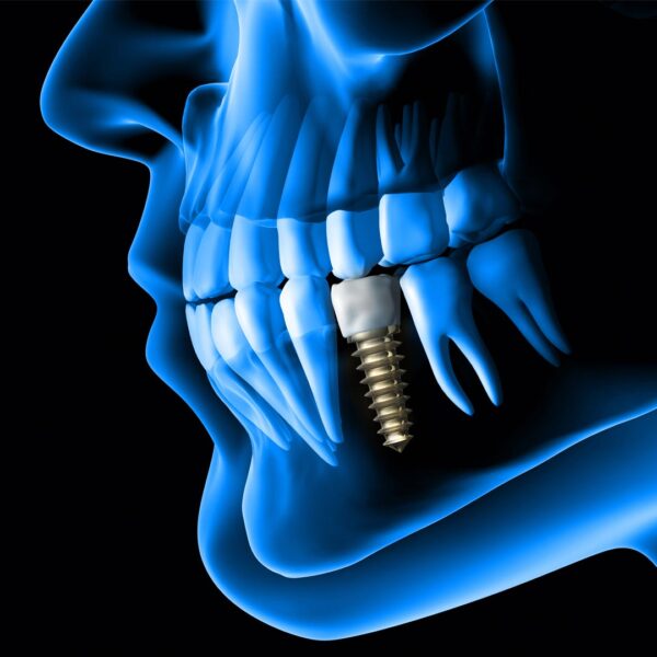 The Best Dental Implants Clinic In Dubai