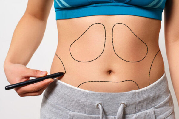  Choose tummy tuck and get from fat to flat tummy
