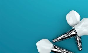 What is The Right Size Dental Implant
