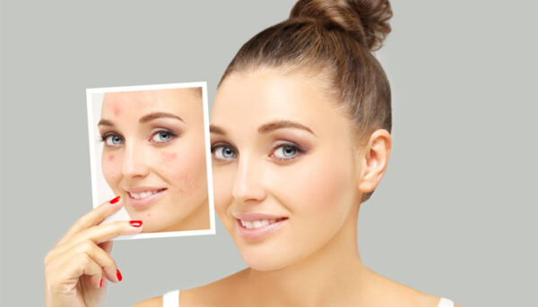Acne Scar Removal from the Best Aesthetic Clinic: Is It Good?