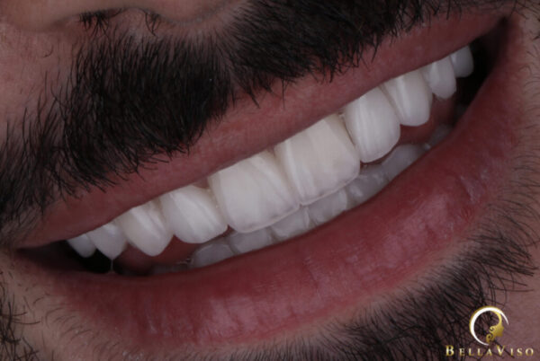 Achieve a Hollywood Smile With Dental Veneers and Dental Implants