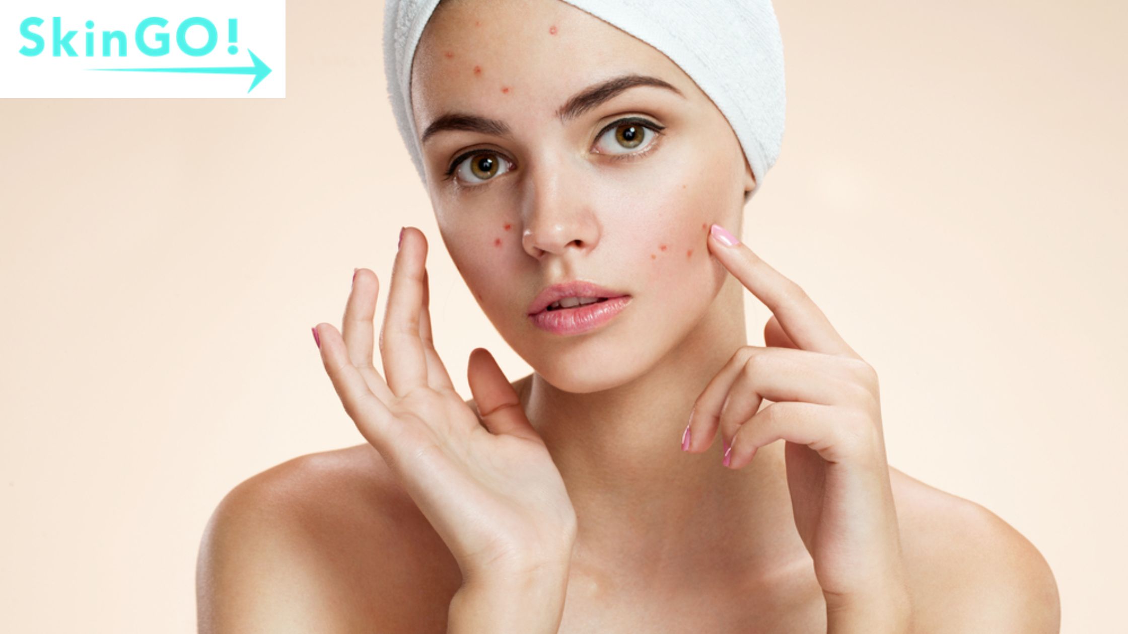 skin treatment for acne