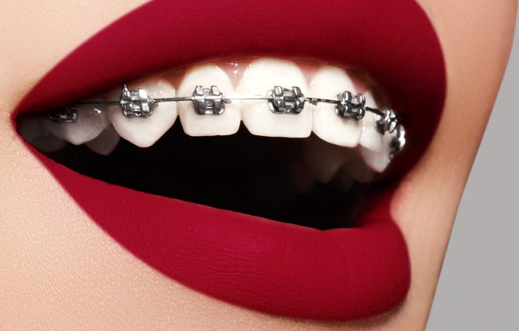 dental braces in dubai,