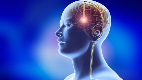 Brain Implants Market | Industry Trends and Forecast to 2030