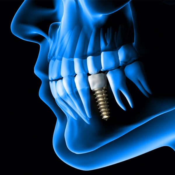 Affordable Dental Implant Clinic in Dubai