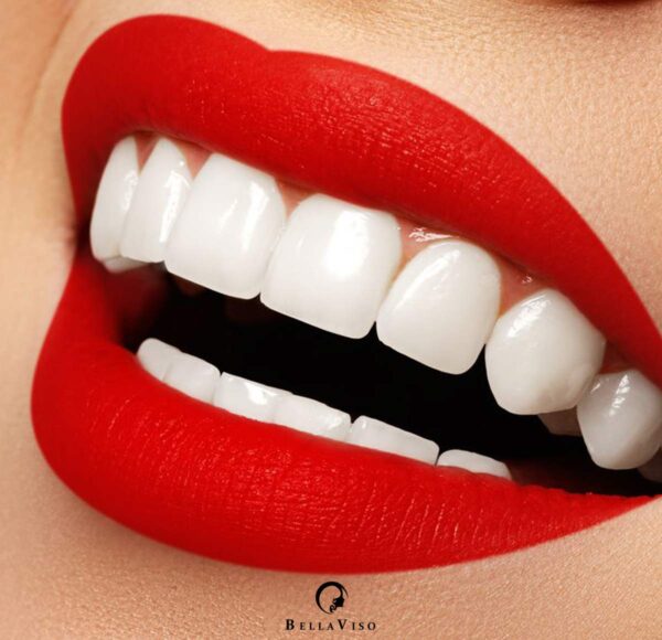 Dental Veneers Treatment in Dubai