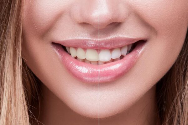 Teeth Whitening  Effects