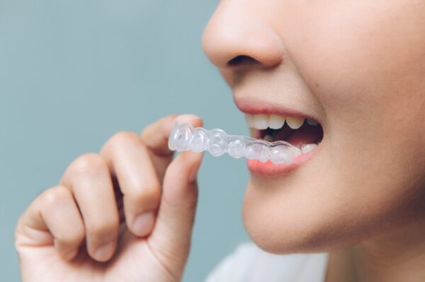 5 Unique Reasons to Opt for Clear Braces