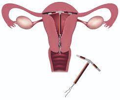 Could an IUD be right for you?