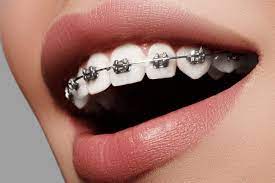 How much do braces cost per month?