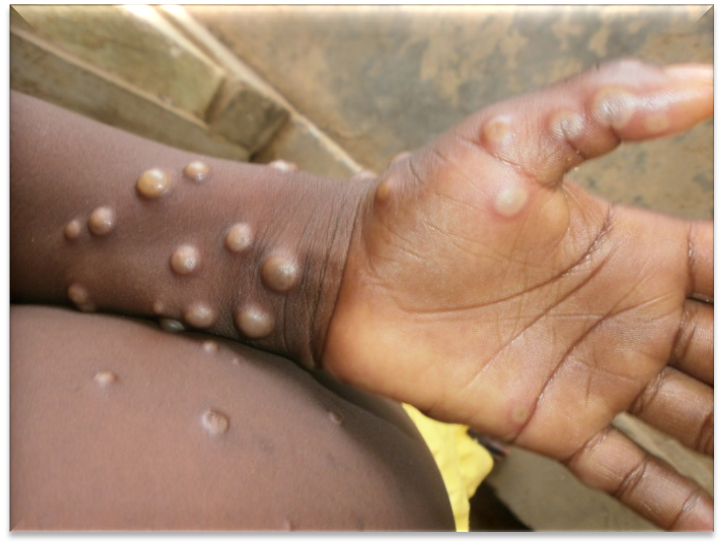 Monkeypox Origin, symptoms and types of contagion