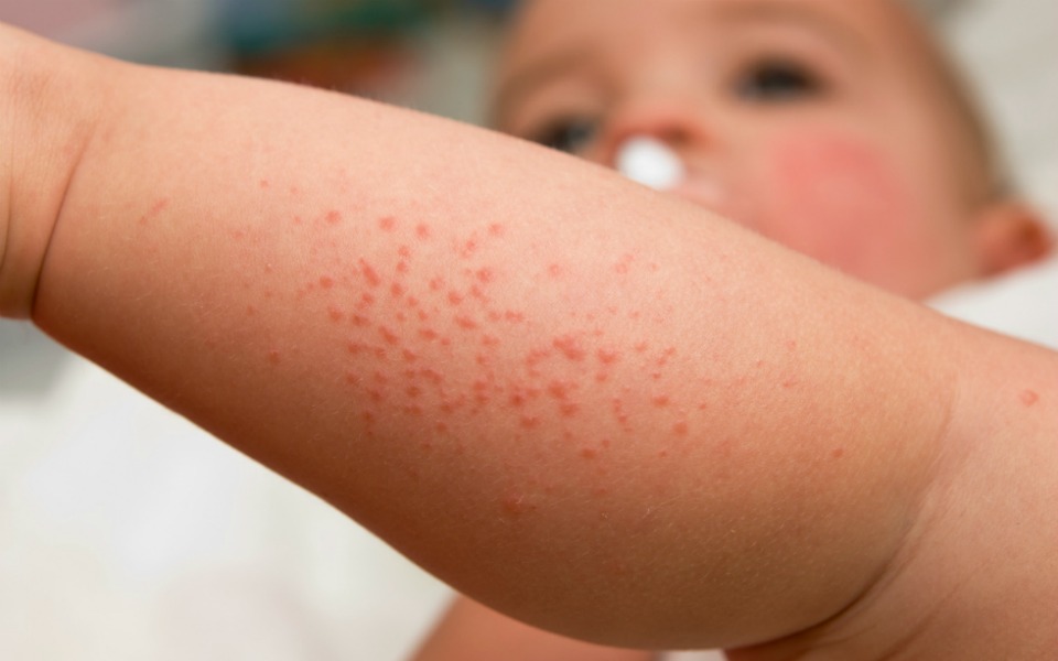 Common Skin Issues in Children